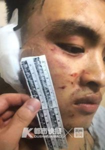 借20元钱不还被咬掉半边耳朵